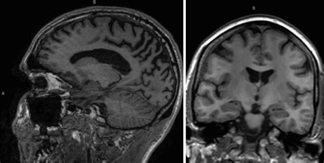 Fig 11 8 Posterior Cortical Atrophy Precuneus Atrophy