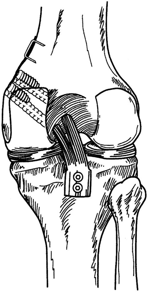 Arthroscopically Assisted Quadriceps Double Bundle Tibial Inlay