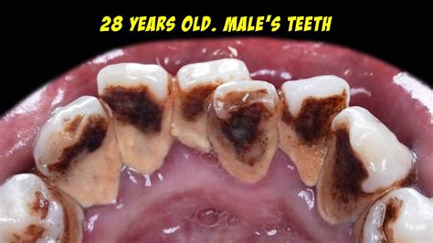 Brownish Black Tartar Very Difficult To Clean Scaling Dentist