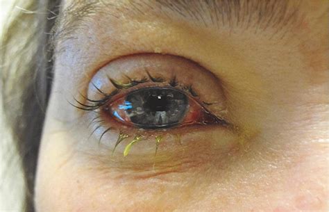 Epidemic keratoconjunctivitis with crusting lid edema and conjunctival ...