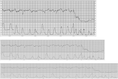 Figo Consensus Guidelines On Intrapartum Fetal Monitoring Cardiotocography Ayres‐de‐campos