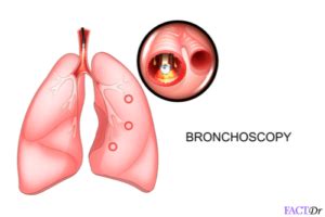 Bronchoscopy: Definition, procedure, biopsy , & risks - FactDr