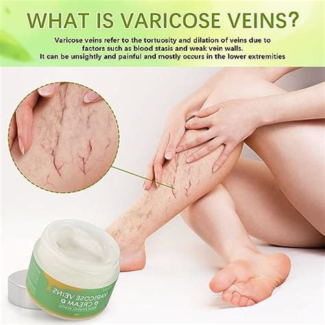 Snapklik 1PCS Varicose Veins Cream Varicose Vein Repair Cream