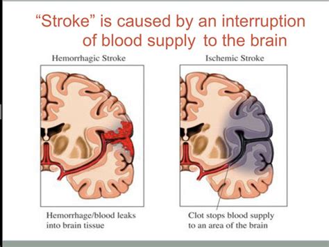 Stroke Flashcards Quizlet