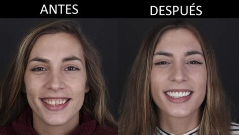 Caso Dental Laura Tratamiento De Est Tica Dental Cl Nica Dental Padr S