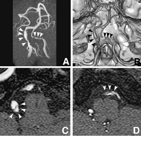 Studies Obtained On Admission A Magnetic Resonance Mr Angiogram