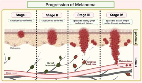 An Illustration Of Melanoma Progression Download Scientific Diagram