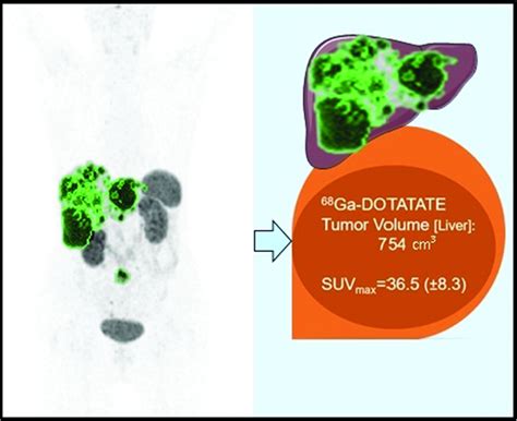 Quantitative 68Ga DOTATATE PET CT Parameters For The Prediction Of