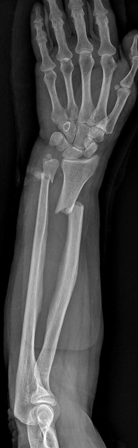 Right Distal Radius Fracture