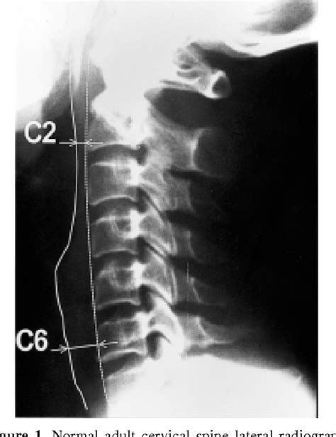 Table 2 From Prevertebral Soft Tissue Measurements On Lateral