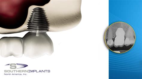 Post Extraction Molar Replacement With Dental Implants Southern Implants