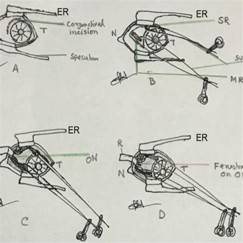 (PDF) Optic Nerve Sheath Fenestration (ONSF): Indications, techniques ...