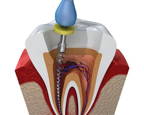 Endodoncia en Cancún - Ro Dental