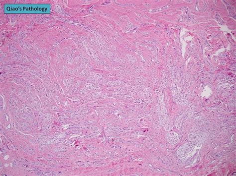 Flickriver Photoset Traumatic Neuroma By Qiaos Pathology Art And