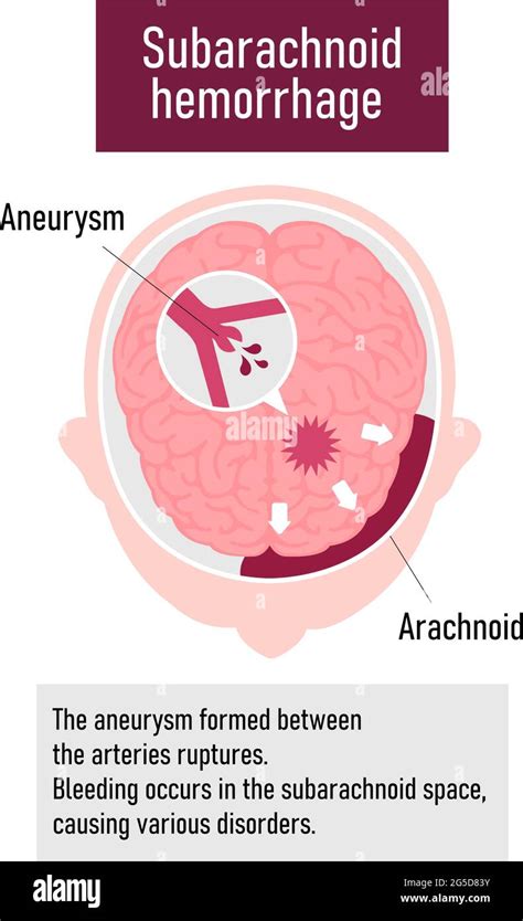 Types Of Human Brain Stroke Vector Illustration Subarachnoid