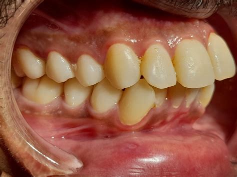 Figure Angle Class I Molar Relationship Statpearls Ncbi Bookshelf