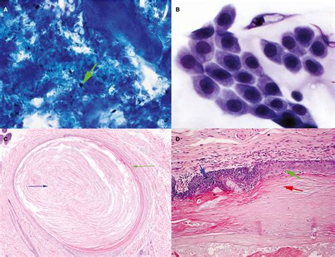 Sebaceous Cyst Dog Cytology