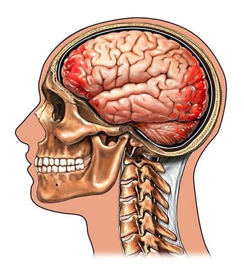 Hemorragia Cerebral Sintomas Tipos Intraparenquimatosa Consequências