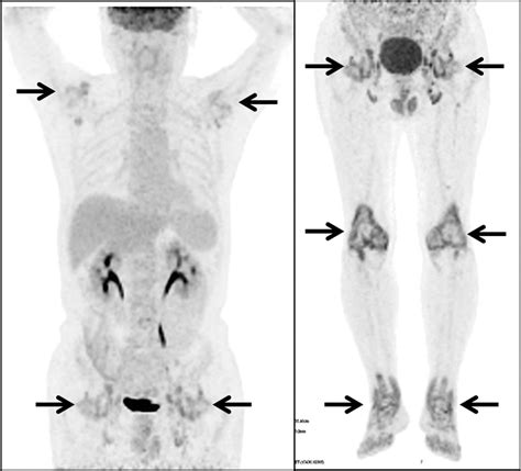 Remitting Seronegative Symmetrical Synovitis With Pitting Ed