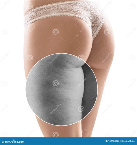 Female Buttocks Before And After Cellulite Treatment Stock Photo