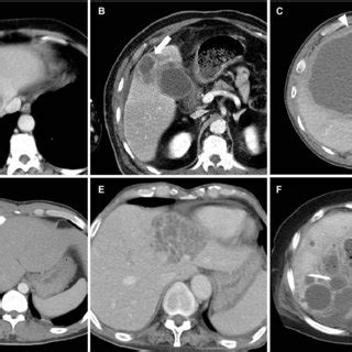 Computed Tomographic Findings Of Liver Abscess A Internal Septation