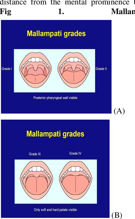 Correlative Value Of Airway Assessment By Mallampati Classification And