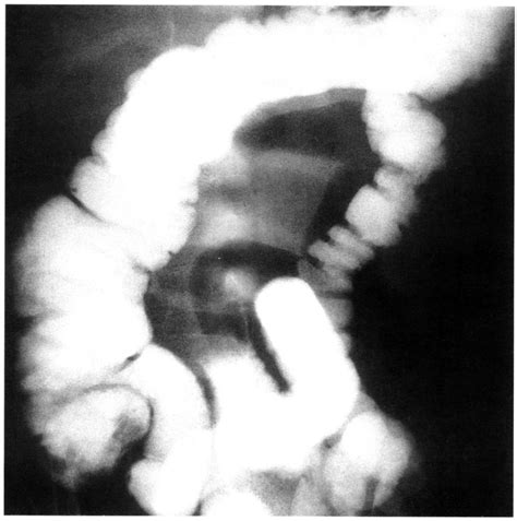 Ileoileal Intussusception A Report Of Four Cases Annals Of Saudi