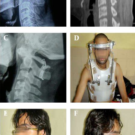 Type II Dens Fracture | Download Scientific Diagram