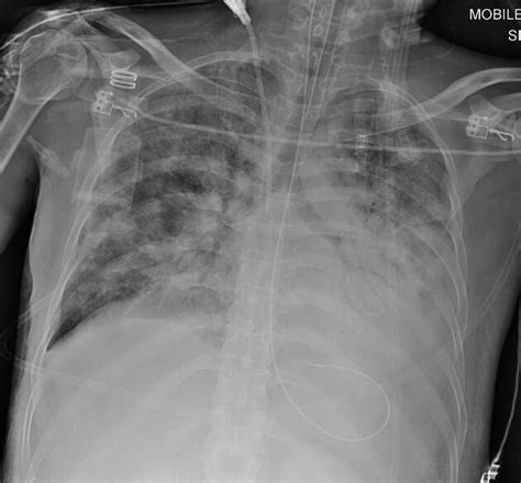 Air Bronchograms On Cxr