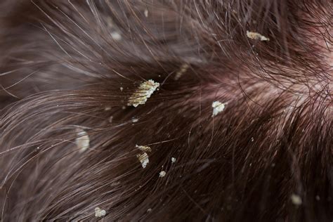 Dermatite seborreica e caspa o que é sintomas e como tratar Dra