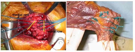 Systematic Review Of Lesser Tuberosity Osteotomy Techniques Outcomes