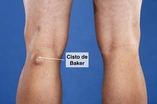 Quiste de Baker qué es síntomas y tratamiento