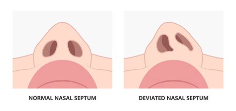 Deviated Nasal Septum - Diagnosis & Treatment | Aglow ENT Centre