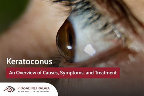 Keratoconus An Overview Of Causes Symptoms And Treatments