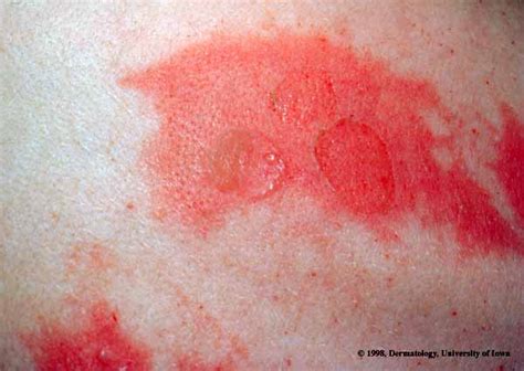 Scalded Skin Staph Infection