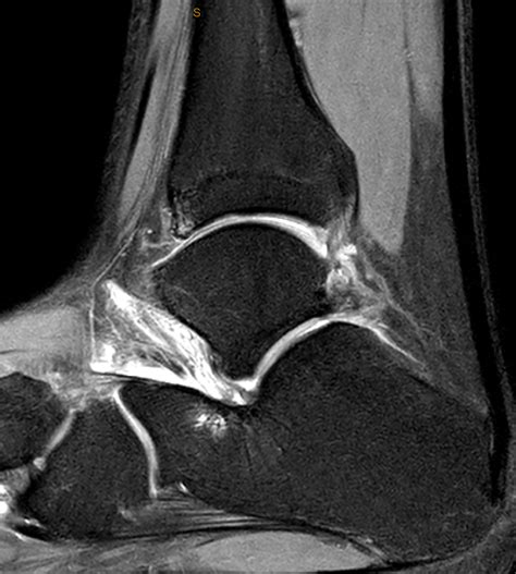 Ankle Impingement David Shepherd