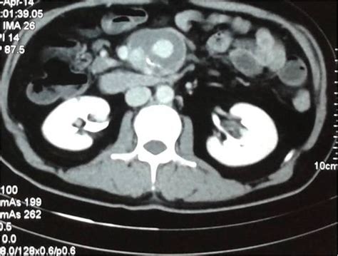 Superior Mesenteric Artery Ct Scan