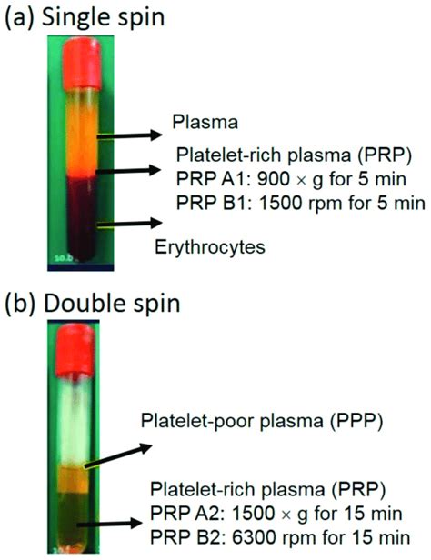 Photograph Of The Platelet Rich Plasma Prp A The Prp A1 And B1