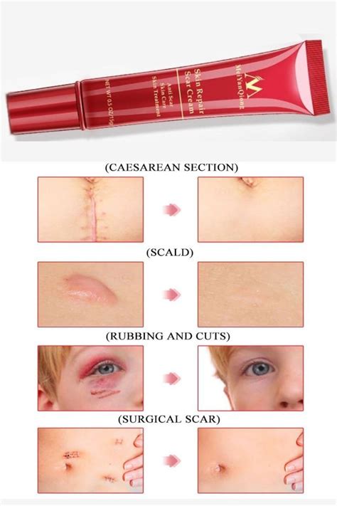 Scar Removal Cream