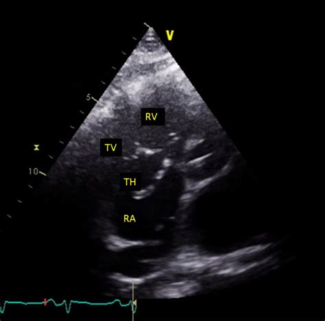 Clot In Transit A Case Of Acute Pulmonary Embolism Bmj Case Reports