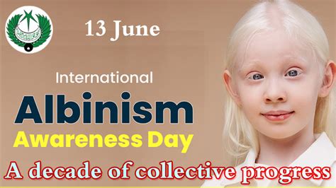 Intl Albinism Awareness Day Being Observed Today