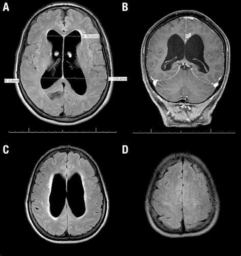 Severe Hydrocephalus Mri