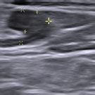 Left Supraclavicular Lymph Node With Preserved Fatty Hilus And