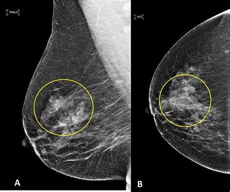 Clinical And Imaging Features Of Idiopathic Granulomatous Mastitis