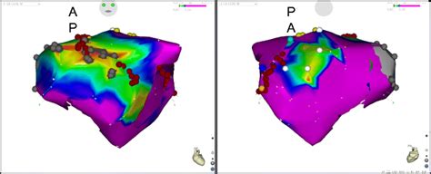 Three Dimensional Electroanatomical Map Of The Left Atrium After Left