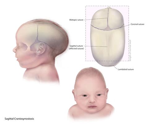 Craniosynostosis Lifespan