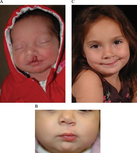 Unilateral Cleft Lip Before And After