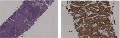 Histologic specimens of fine needle aspirating biopsy of right axillary... | Download Scientific ...