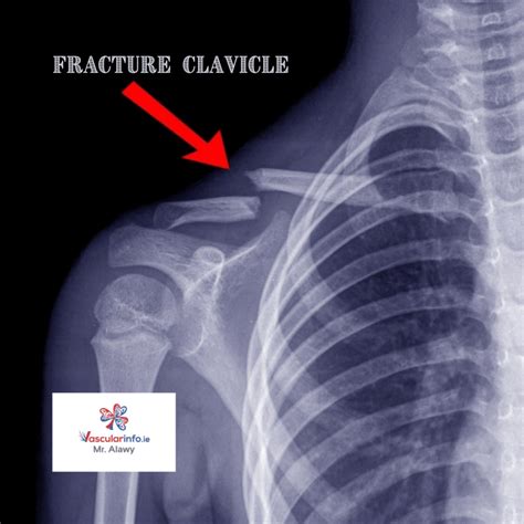 Thoracic Outlet Syndrome - Vascular Info