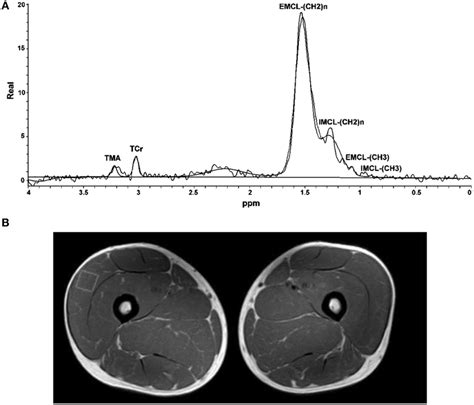 ¹H MRS spectra of skeletal muscle and fitted data A Placement of